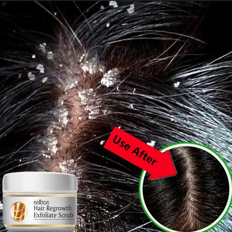 Hair Care Dandruff - Fast Anti Dandruff Hair Treatment Scrub