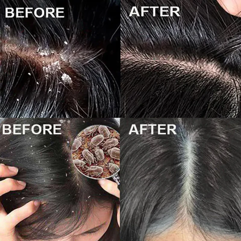 Fast Anti Dandruff Hair Treatm - Hair Care Dandruff 评论和价格